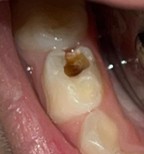 Before stainless steel crown